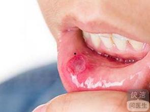 吃瓜吃的口腔溃疡,口腔溃疡背后的“吃瓜”真相